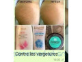traitement-des-vergetures-small-3
